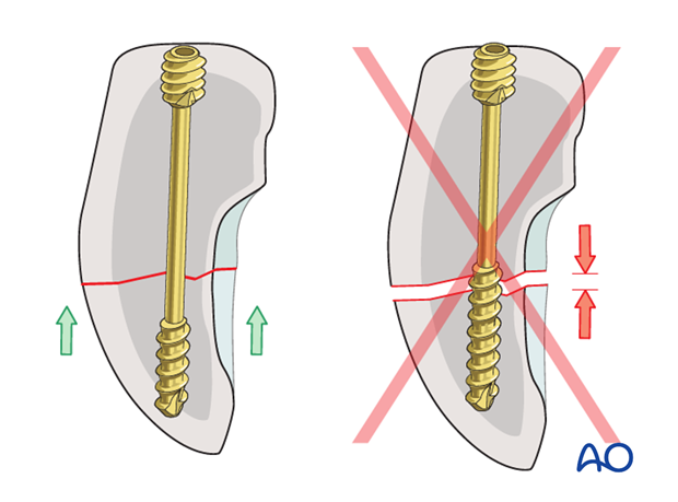 Scaphoid – Undisplaced waist fracture – Percutaneous screw fixation