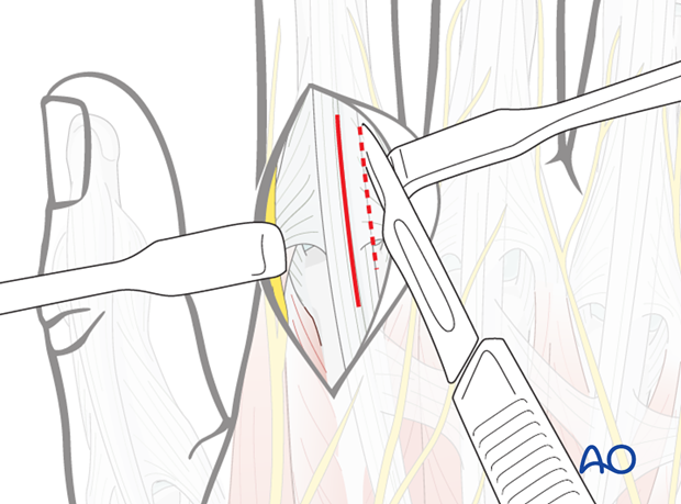 tension band wiring