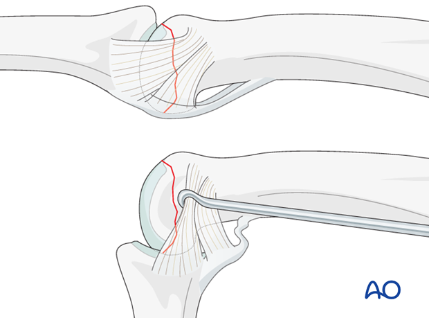 T-shapred fracture of the proximal phalanx PIP joint – Lag screw fixation