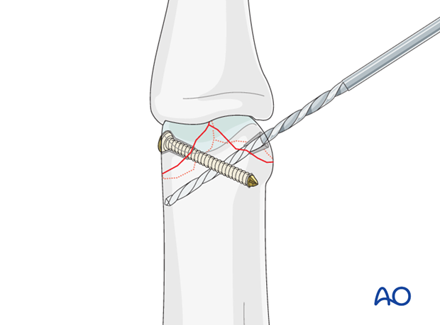 T-shapred fracture of the proximal phalanx PIP joint – Lag screw fixation