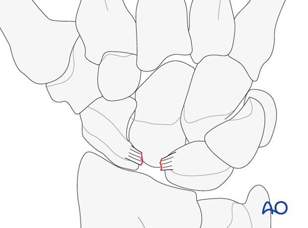 Complete scapholunate (SL) ligament rupture