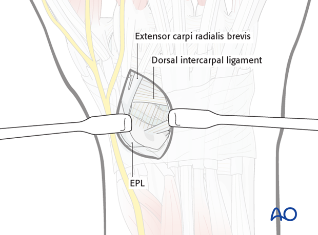 Dorsal approach to the scaphoid