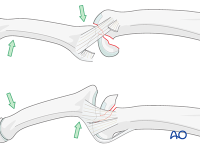 Lag screw fixation for Proximal phalanx, articular (head), unicondylar ...