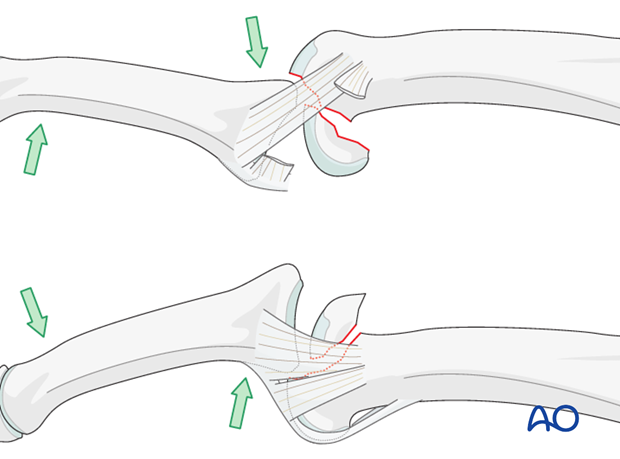 Unicondylar fracture dislocatino of proximal phalanx PIP joint – Lag screw fixation