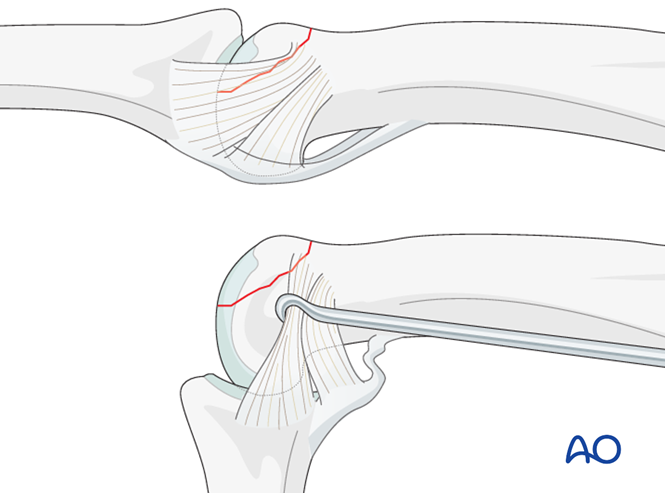 Lag Screw Fixation For Proximal Phalanx, Articular (head), Unicondylar 