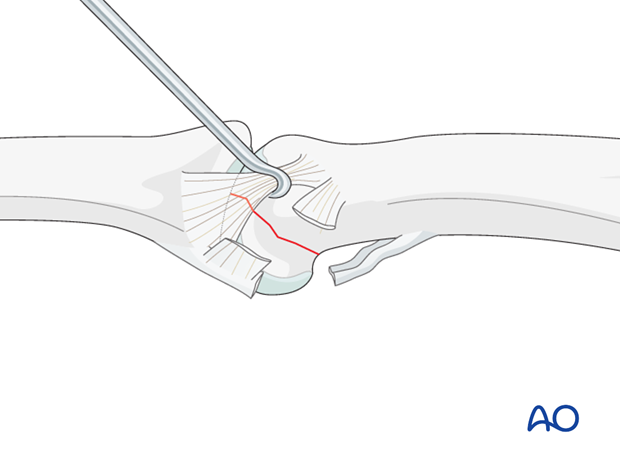 Unicondylar fracture dislocatino of proximal phalanx PIP joint – Lag screw fixation