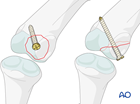 proximal phalanx articular head unicondylar fracture dislocation