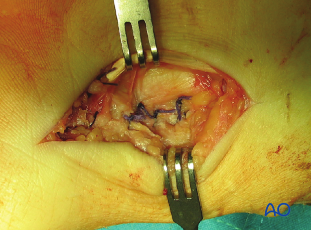 Palmar approach to the scaphoid – Wound closure