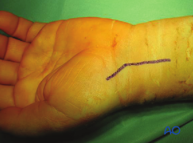 Palmar approach to the scaphoid - Incision