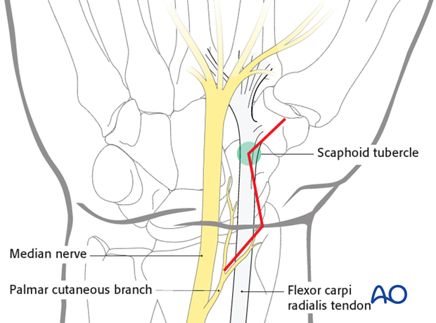 Palmar approach to the scaphoid - Incision