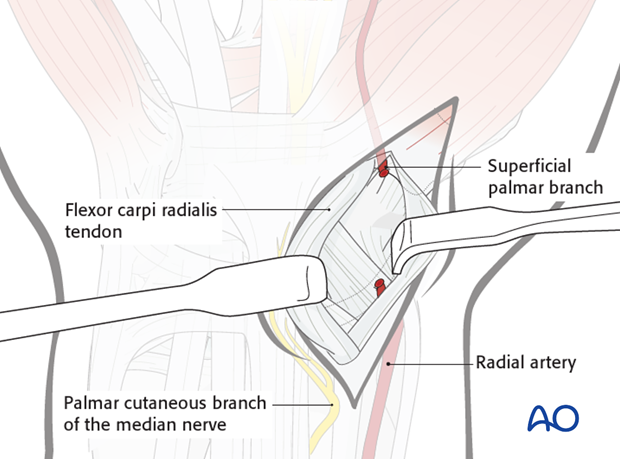 Palmar approach to the scaphoid – Opening of CFR sheath
