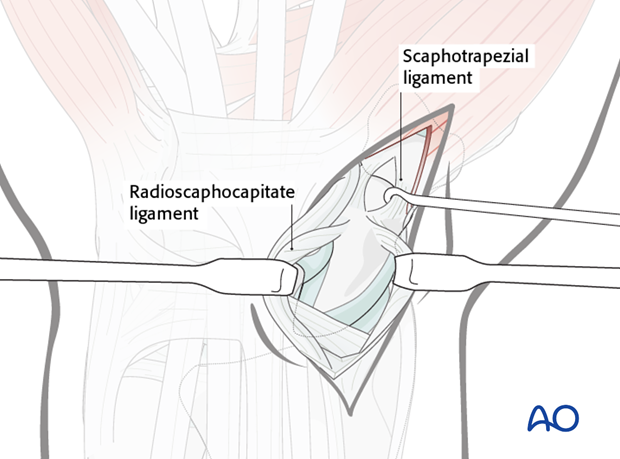 Palmar approach to the scaphoid – Exposure of scaphotrapezial joint