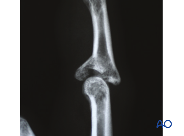 Typically, hyperextension of the proximal interphalangeal (PIP) joint causes an avulsion fracture of the volar ...