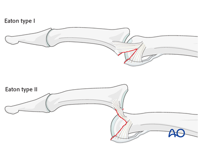 Hemi-hamate arthroplasty with bone graft for Proximal, multifragmentary