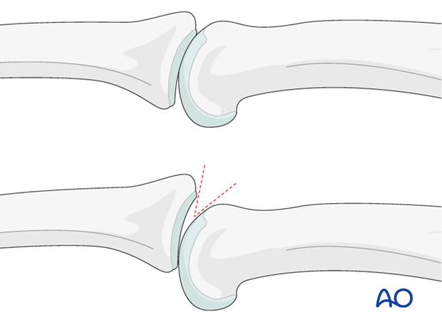 AP and true lateral x-rays are necessary for diagnosis. Be careful to avoid overlap of other fingers in the x-rays.