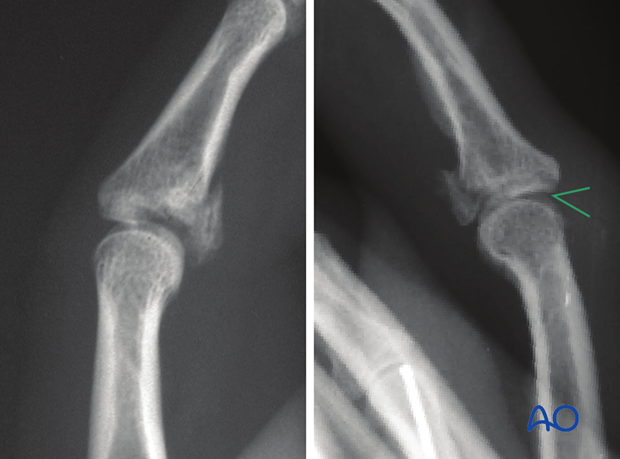 AP and true lateral x-rays are necessary for diagnosis. Be careful to avoid overlap of other fingers in the x-rays.