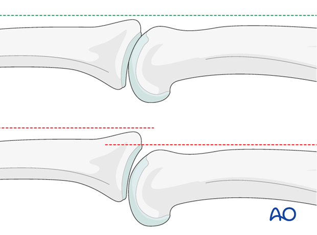 In the lateral view, the proximal and middle phalanges should be collinear. Any axial malalignment is a clear indication of ...