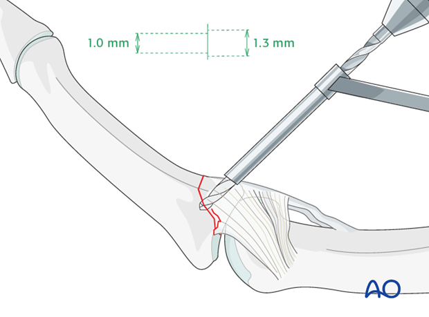 Maintaining the reduction with pressure from a drill guide, drill a gliding hole using a 1.3 mm drill bit for a 1.3 mm screw.