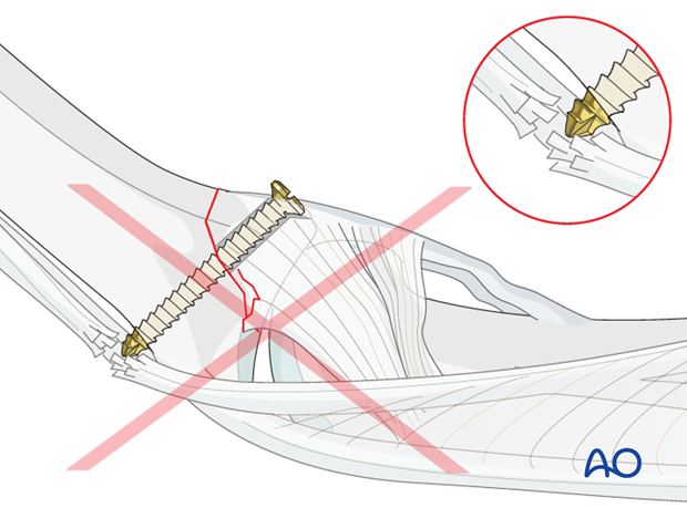 Too long a screw irritates extensor tendon