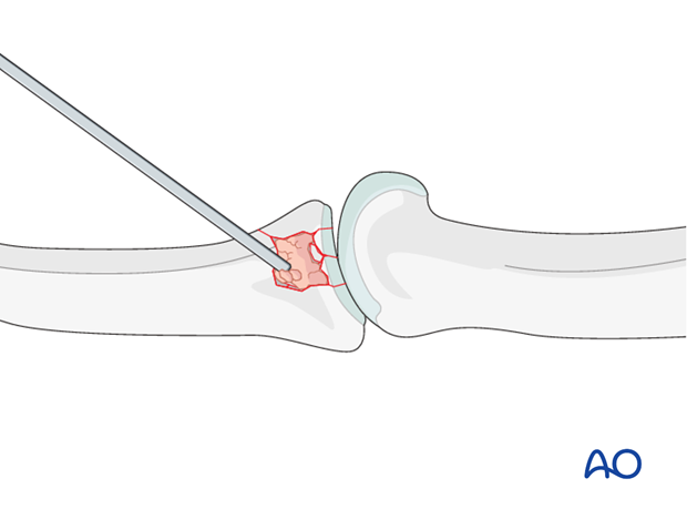Use a pusher instrument to impact the bone graft and fill the whole fracture cavity.