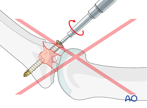 Be careful not to overtighten the screw as this may result in comminution of the palmar marginal fragment.
