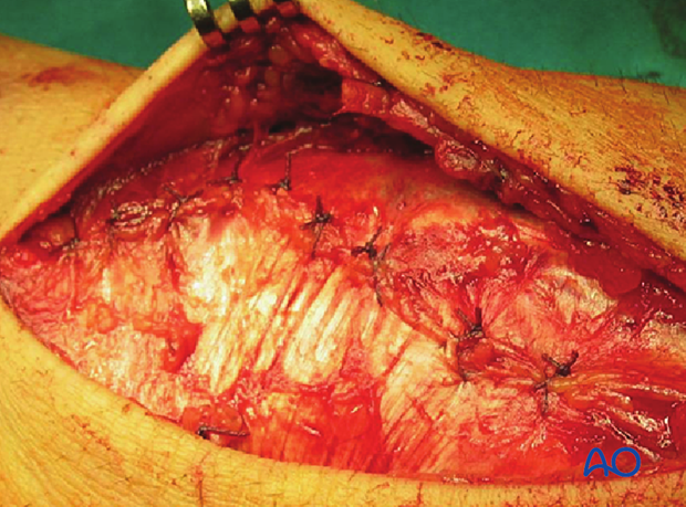 Combined approach to perilunate fractures and dislocations – Wound closure