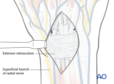 Combined approach to perilunate fractures and dislocations