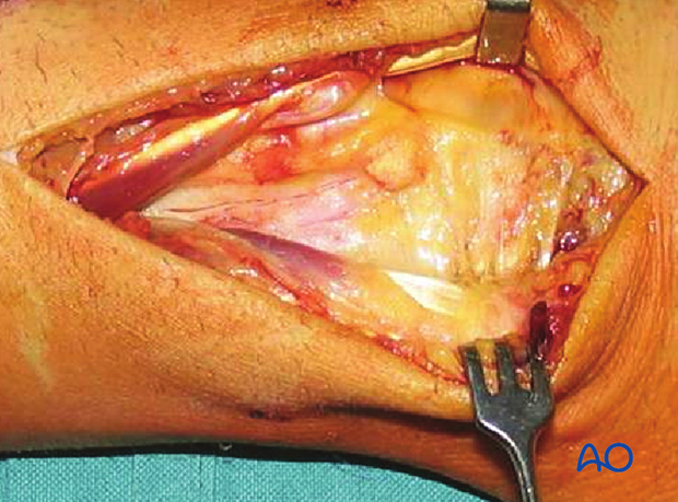 Combined approach to perilunate fractures and dislocations - Exposure