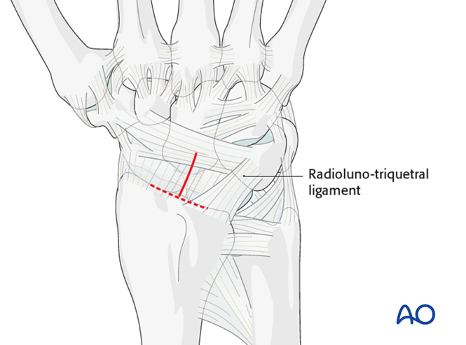 Combined approach to perilunate fractures and dislocations