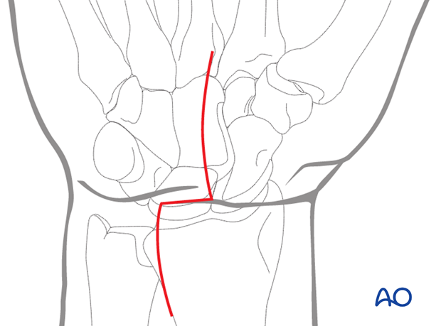 Combined approach to perilunate fractures and dislocations - Incision
