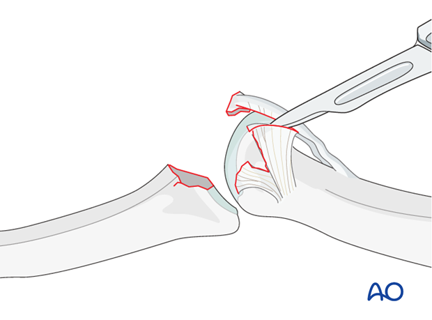 Incise the interval between the volar plate and the accessory collateral ligament. This will allow mobilization ...