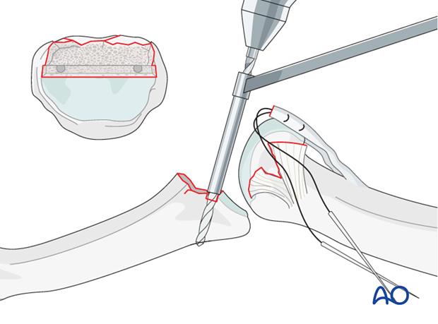 Use fine multifilament sutures with double-mounted straight needles to insert a criss-cross stitch (Bunnell) in each side ...