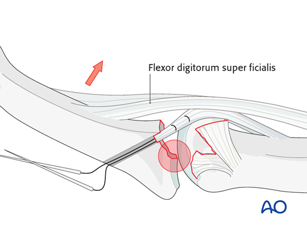 If the drill holes are not immediately adjacent to the articular cartilage, the pull of the flexor digitorum superficialis ...