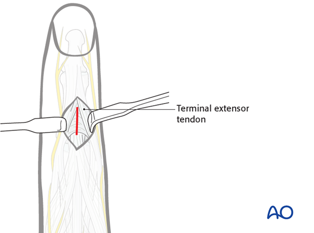 Make a dorsal incision of about 1 cm distal to the insertion of the central extensor slip, incising the triangular ligament.