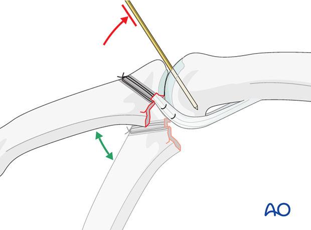 A K-wire is introduced between the condyles of the proximal phalanx, in order to block the last 20-30 degrees of extension, ...