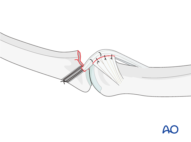 If there is lateral instability, resuturing of the accessory collateral ligament to the volar plate is recommended.