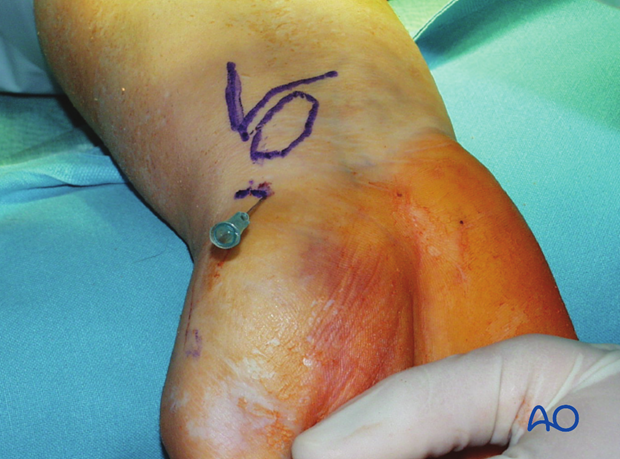 Anatomical structures for minimally invasive access to the scaphoid