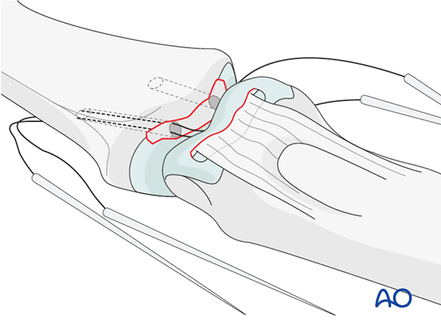 Use 4.0 multifilament nonabsorbable sutures with double-mounted straight needles. Wrap each suture around the small ...