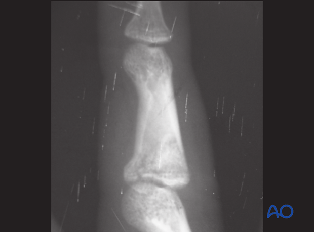 Extensive comminution with impaction of the subchondral metaphysis is a typical indication for bone graft reconstruction.