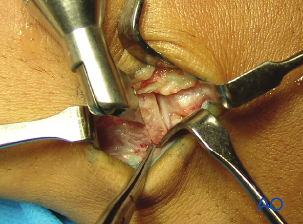 Cut the osteocartilagineous graft from the hamate. Use a fine oscillating saw for the vertical and horizontal cuts.