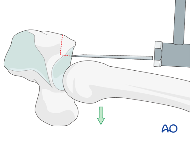 In order to free the graft fragment from the hamate, dislocate the metacarpals palmarly, and use a chisel as a lever to ...