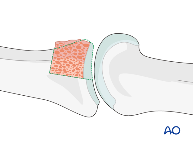 Insert the perfectly modelled bone graft to reconstruct the articular surface. Ensure that the articular cartilages of the ...