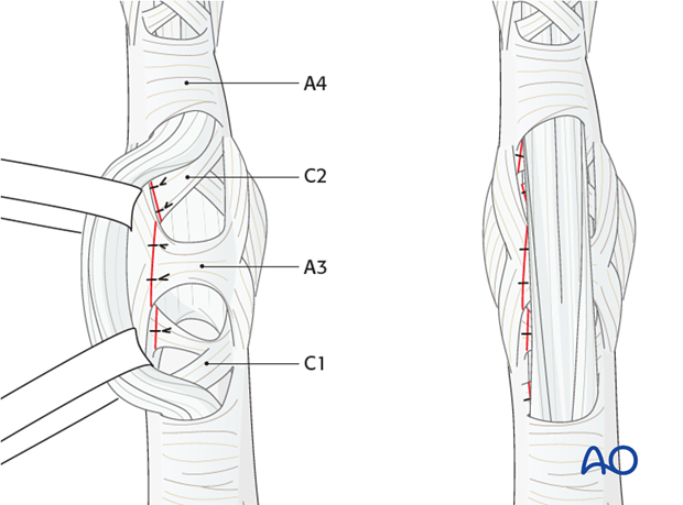 The flap of the C1, A3, and C2 pulleys is passed beneath the flexor tendons, and sutured to the opposite side.