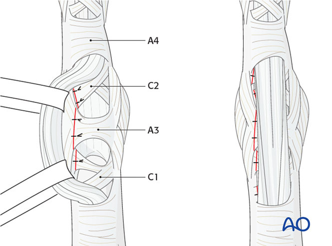 Hemi-hamate arthroplasty with bone graft for Proximal, multifragmentary