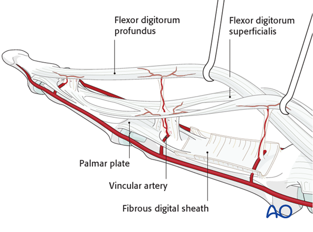 The vincular arteries, essential for vascularization of the flexor tendon, are at risk in palmar avulsion injuries.