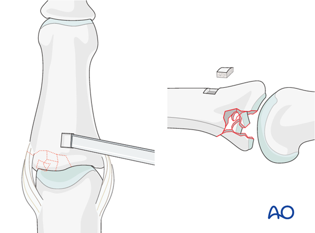 Use a small osteotome to cut a rectangular window into the cortical bone. Remove the osteotomized bone and carefully ...