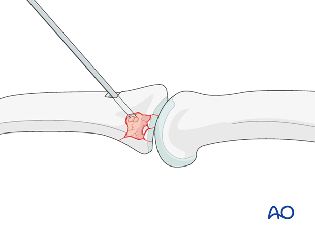 Use a pusher instrument to impact the bone graft and fill the whole fracture cavity. Confirm reduction using image ...