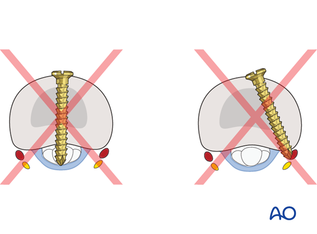If too long a screw is inserted, flexor tendon irritation may result.