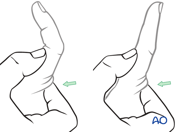 In order to recognize detachment of the central slip, ask the patient to extend the PIP joint with the MP joint in ...