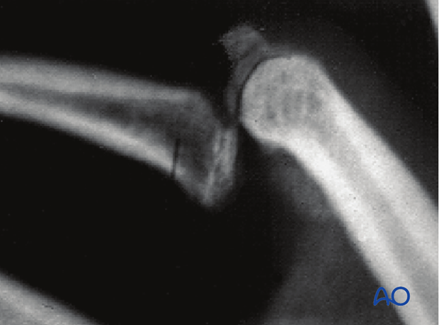 An avulsion fracture of the central slip can usually be reduced by full extension.